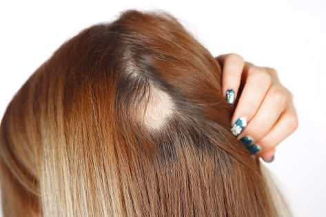 jizvící alopecie a nejizvící alopecie