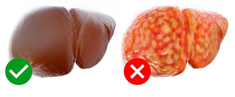 zdrava - zamaščena jetra